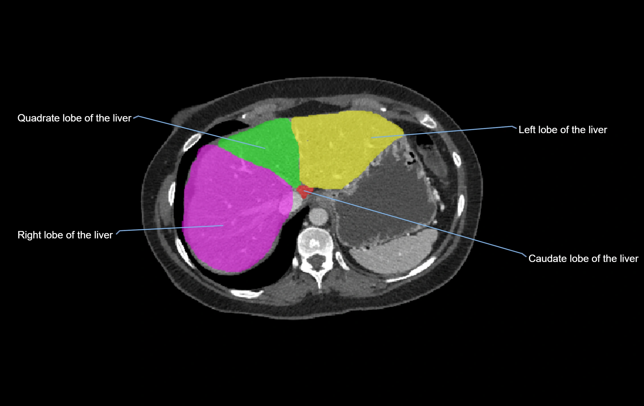 CT lliver lobes axial cross sectional anatomy labelled image -00062.webp